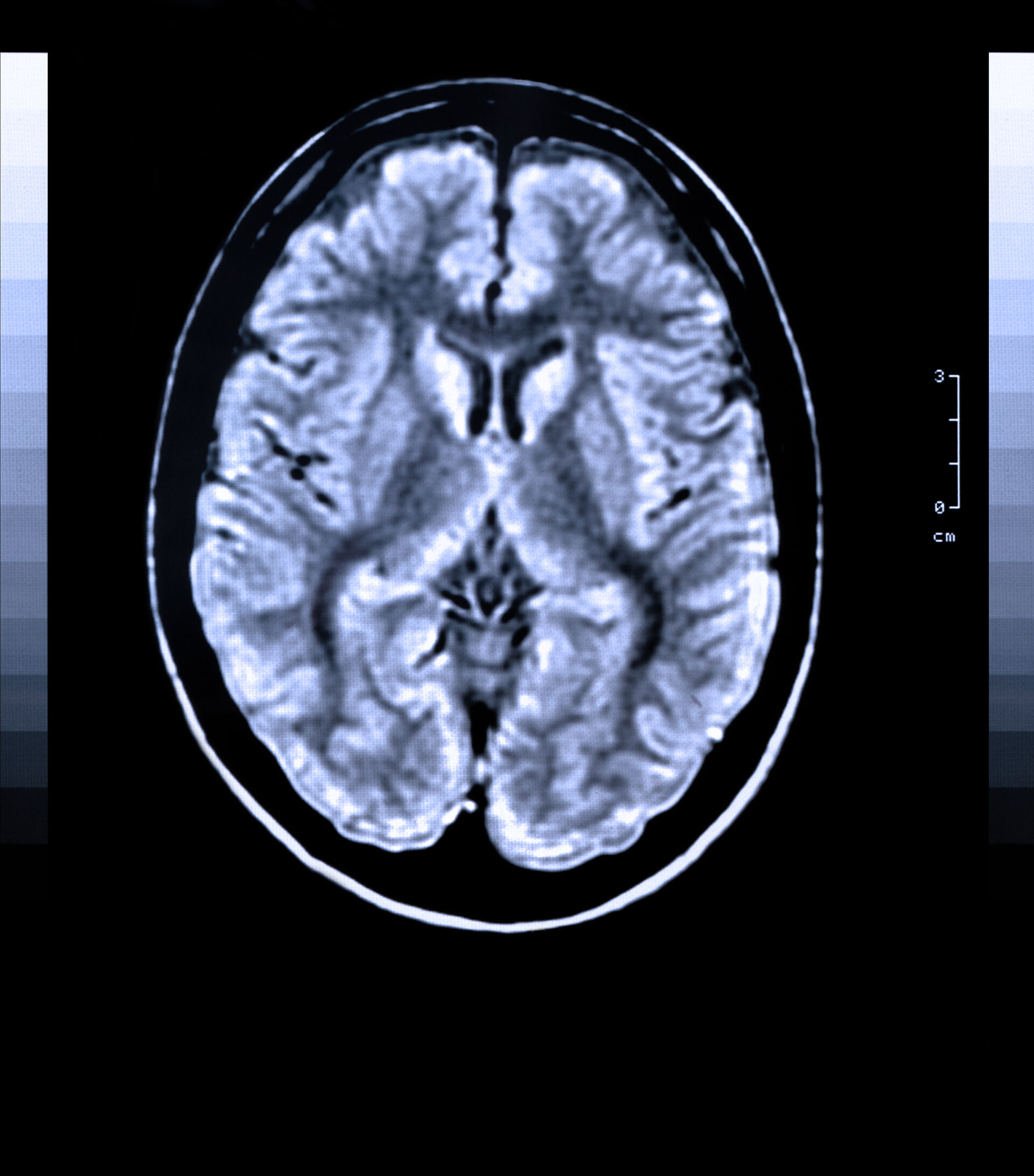 MR bilde av hjerne