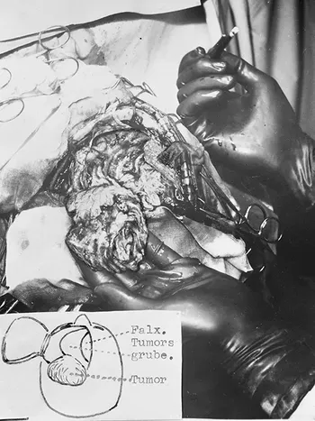 Foto med anmerkninger fra desember 1938 som viser kirurgisk fjerning av en hjernesvulst fra en 42 år gammel kvinne. Bildene er tatt for Rikshospitalets Nerveavdeling, som det het den gang. &quot;Tumors grube&quot; er det vi i dag ville kalt tumorkaviteten. &quot;Falx.&quot; er falx cerebri, eller sigdfolden, en fold av dura mater som går ned mellom de to hjernehalvdelene. Vi vet ikke hvem operatøren var eller hvordan det gikk med pasienten. Dette er altså før antibiotika ble tatt i bruk, og mulighetene til behandling av postoperative infeksjoner var færre enn i dag. Foto: Sæther, Røntgen-Radiuminstituttet, Rikshospitalet.